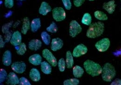 Станут ли стволовые клетки «панацеей» от ишемических инсультов?