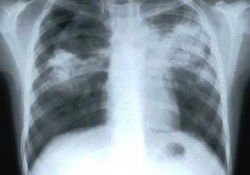 Найдена одна из главных причин распространения неизлечимого туберкулеза