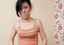 Врачи вернули нормальную внешность 16-летней девушке, выглядевшей на 60