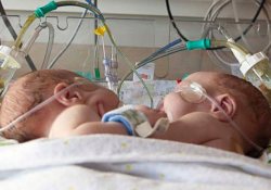 Американские врачи успешно разделили сросшихся близнецов