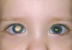 Рак глаз помогает выявить фото ребенка