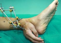 Китайские медики снова удивили: рука, выращенная на ноге