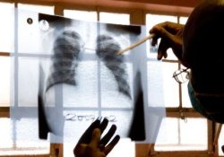ЮАР: власти страны создают туберкулезный «ящик Пандоры»