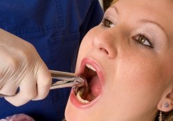 Удалять или не удалять зубы перед операцией на сердце – вот в чем вопрос?