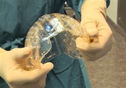 Трансплантация черепа: пластик вместо титана
