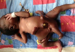 Четырехрукий и четырехногий мальчик избавился от лишних конечностей