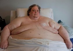 Операция по уменьшению желудка не спасла самого толстого человека планеты…