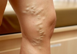 Варикозную болезнь ног станут лечить с помощью «биологического» клея