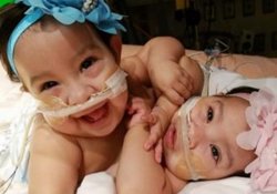 Разделение 10-месячных сросшихся близнецов – новый успех хирургов