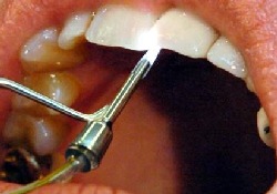 По просьбе душевнобольного пациента немецкий стоматолог удалил ему все зубы…
