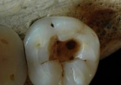 Первые «стоматологи» появились на нашей планете еще 14 000 лет назад