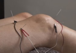 Электроакупунктура – необычный и перспективный метод лечения гипертонии