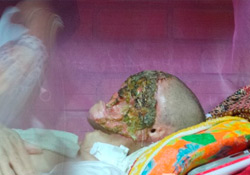 Загадочная болезнь практически полностью уничтожила лицо жителя Вьетнама