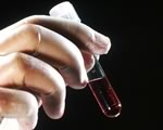 Анализ крови может предсказать опасность раcпространения рака простаты