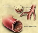 Новый взгляд на атеросклероз