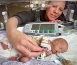 Тэйлор Гарднер – самая маленькая в мире девочка с кардиостимулятором