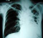 Глобальный фонд выделил Украине 100 миллионов долларов на борьбу с туберкулезом