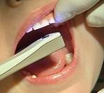 Новый прибор точно определяет степень поражения зуба кариесом и необходимость его пломбирования