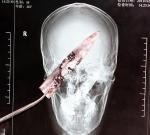 Незамеченное врачами 10-сантиметровое лезвие в голове годами напоминало о себе лишь мигренью