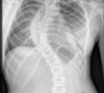 Менее чем за год неумолимая болезнь изогнула позвоночник девочки на 90°