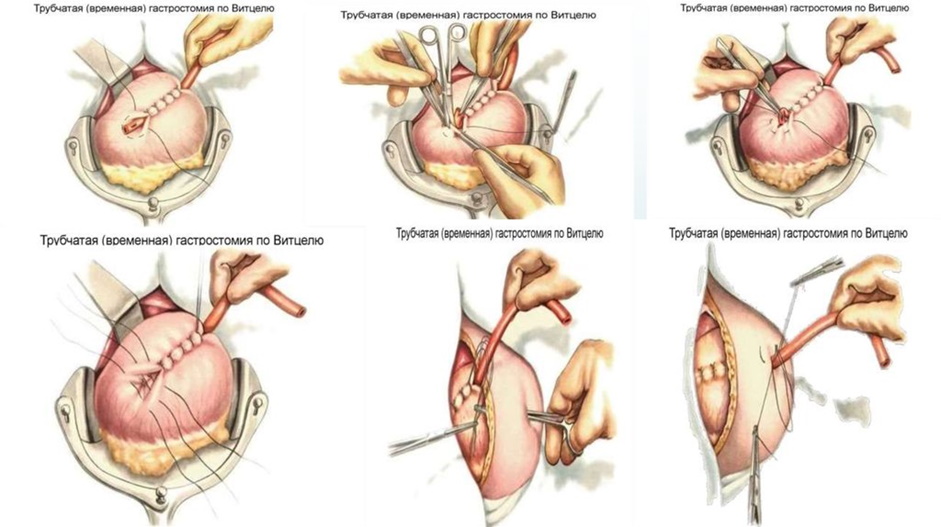 хирургическое вмешательство в лечении рака
