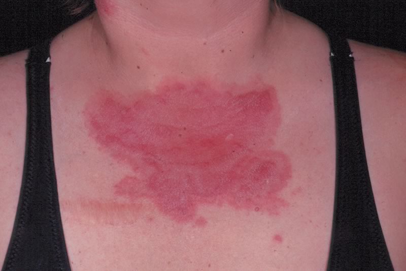 Lupus facial rash - Mayo Clinic