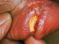Сифилис: первичный шанкр (язва) на пенисе мужчины