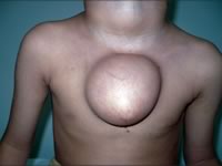 Гигрома