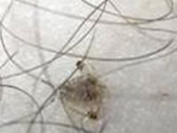 Укусы лобковых вшей сопровождаются зудом, расчесыванием Укусы лобковых вшей сопровождаются зудом, расчесыванием