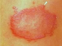 Проказу вызывают палочковидные микроорганизмы Mycobacterium leprae