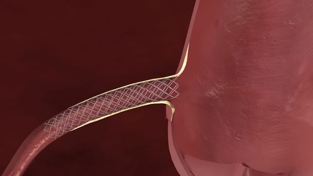Установка уретрального катетера-стента у мужчин
