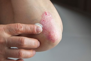 Ургентні прояви побічних реакцій з боку шкіри при медичному застосуванні лікарських засобів. Синдром Лайєлла