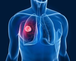 Рак легких: симптомы и методы лечения