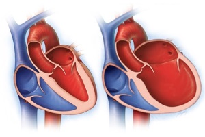 Миокардит и дилатационная кардиомиопатия: проблемы диагностики и лечения