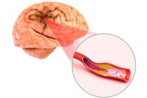 Влияние Кавинтона на функцию эндотелия у больных с хронической ишемией головного мозга