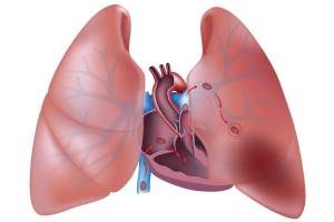 Тромбоэмболия легочной артерии: дискуссия продолжается