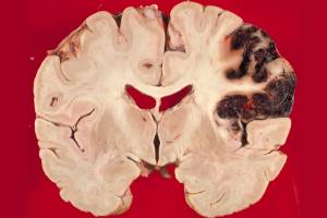 Хроническая ишемия мозга в практике врача-терапевта