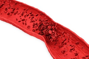 Тромболізис у Західній Україні: поодинокий приклад, втілення мрії чи перший крок на шляху до повсякденної практики?