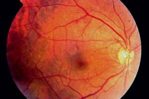Діабетична ретинопатія