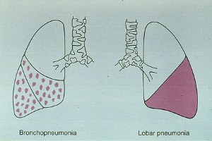 Бронхопневмонія, неуточнена (осередкова зливна пневмонія)