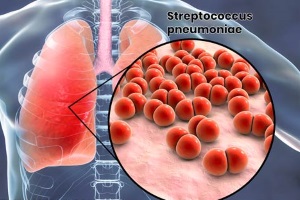 Пневмонія стрептококова (бактеріальні пневмонії)