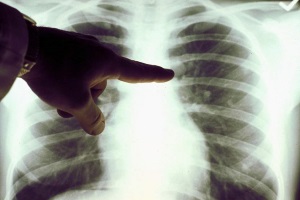 Вади розвитку легенів