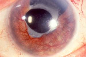 Глаукома неоваскулярная