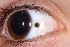 Злокачественные новообразования глазницы (ангиосаркома, фибросаркома, рабдомиосаркома)