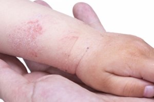 Атопический дерматит: причины, симптомы, диагностика и лечение