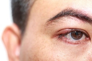 Ячмень на глазу