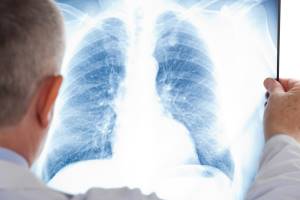 Пневмония: симптомы и лечение воспаления легких