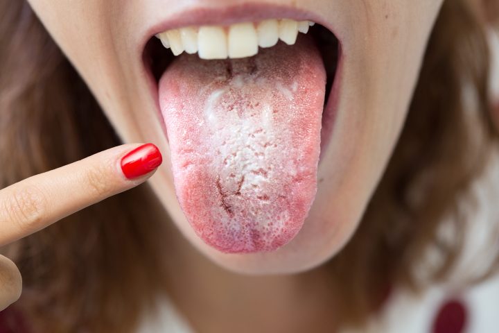 Білий наліт на язиці: причини та як від цього позбутися