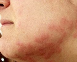 Аллергия на лице лечение