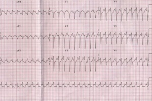 Пароксизмальные суправентрикулярные тахикардии: диагностика и лечение